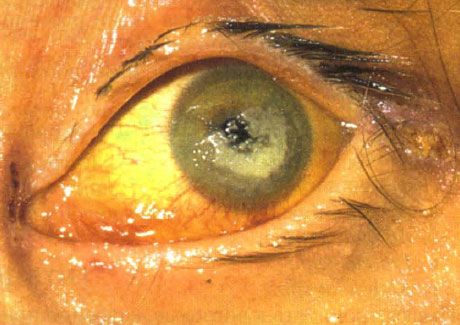 嚴重免疫缺陷兒童念珠菌引起的雙側角膜炎