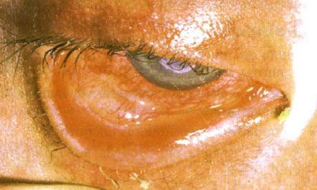 Syndrome Stevens-Johnson。 雙側脫屑性結膜炎伴有壞死區域。 重度角膜炎，導致角膜上出現疤痕。 由於增加了“幹”眼綜合症，情況變得複雜