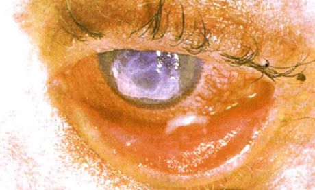Syndrome Stevens-Johnson。 雙側脫屑性結膜炎伴有壞死區域。 重度角膜炎，導致角膜上出現疤痕。 由於增加了“幹”眼綜合症，情況變得複雜