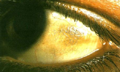 乾眼症。 Bito的斑塊看起來很高，有多層鱗片沉積，結膜部位位於未被眼瞼覆蓋的區域。 正如在這種情況下，病理區域通常是有色的。