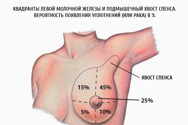 左乳房的象限和spence的腋窩。 海豹（或癌症）的可能性以％