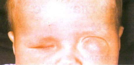 伴有囊腫形成的小眼球（左眼）。 Anophthalmus（右眼）。