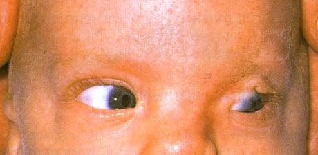 弗雷澤綜合症。 左眼不完全隱眼症。