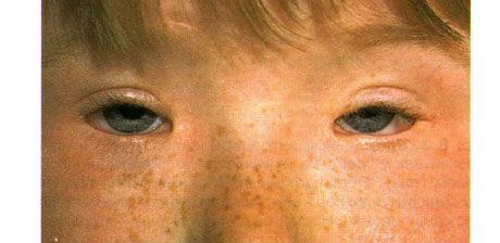 瞼裂綜合徵。 雙側手術下垂，眼瞼痙攣和眼瞼痙攣