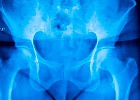 尾骨骨折的症狀和後果