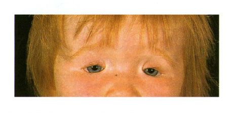 金氏綜合徵患兒眼瞼的雙側結腸瘤。 關閉左眼的狹縫