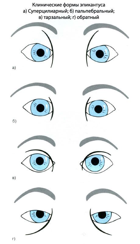 表皮蘚的臨床形式。 a）超睫狀，b）眼瞼，c）t骨，d）反向